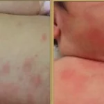 Что такое пеленочный дерматит: определение понятия и суть