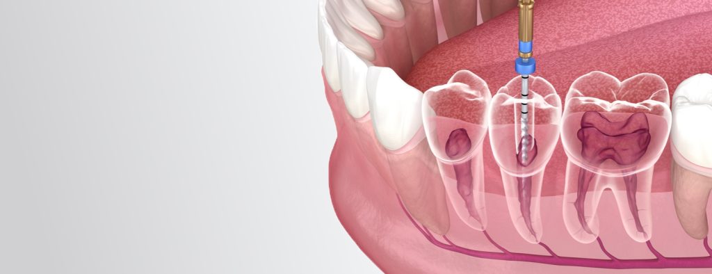 Что такое пульпит и какие его симптомы