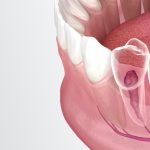 Что такое пульпит и какие его симптомы